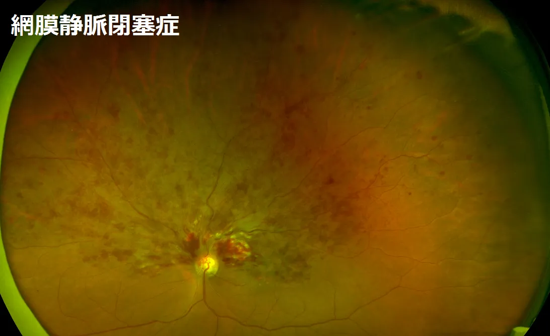網膜静脈閉塞症の状態