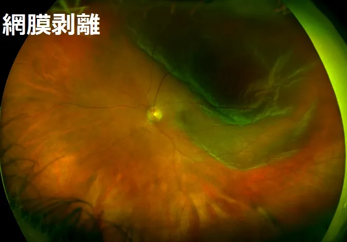 網膜剥離の状態